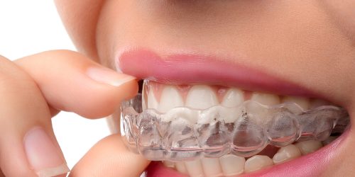 Adult Orthodontics