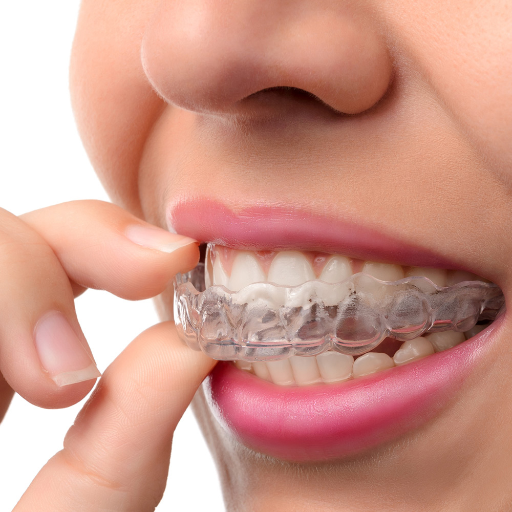 Adult Orthodontics
