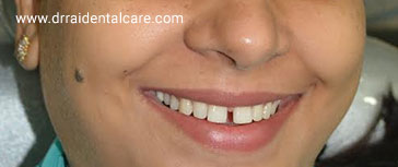 Adult patient desiring correction of teeth.