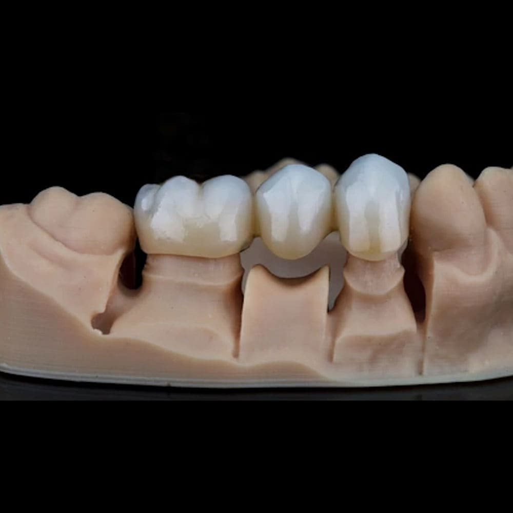 All-Ceramic-CAD-CAM-Metal-Free-Crowns
