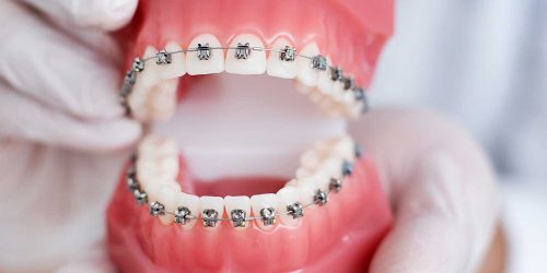 Clear-Aligner-Treatment