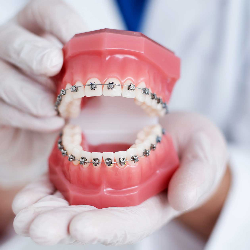 Clear-Aligner-Treatment