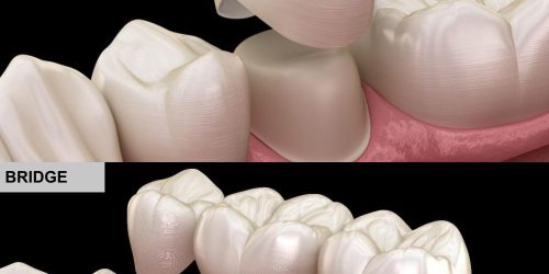 Crown-&-Bridges-Prosthodontics