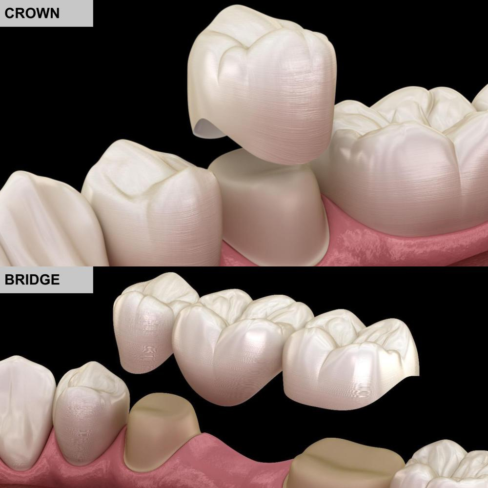 Crown-&-Bridges-Prosthodontics