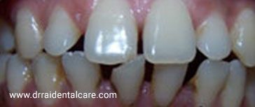 GUM RECESSION