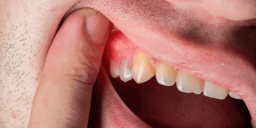 Gum Diseases