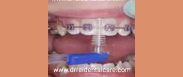 INTERDENTAL BRUSH FOR BRACES
