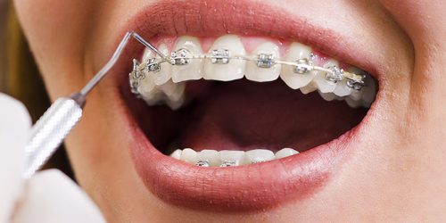 Lingual-Invisible-Braces