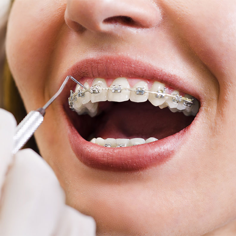 Lingual-Invisible-Braces