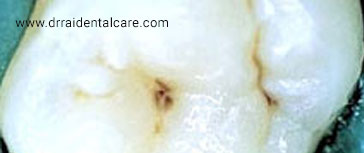 Natural Pits & Fissures Stained & Likely To Lodge Food & Get Carious