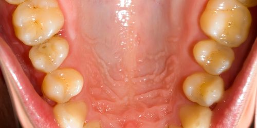 Pit-Fissure-sealants-Preventive-Dentistry