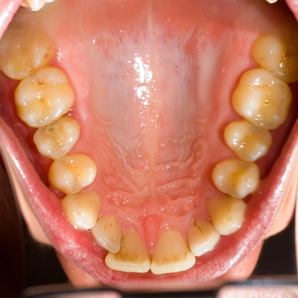 Pit-Fissure-sealants-Preventive-Dentistry