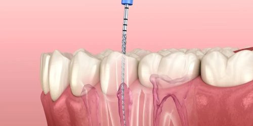 Root-Canal-Treatment-Endodontics