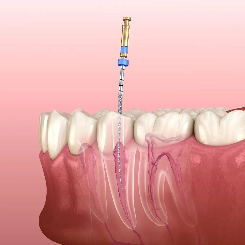 Root-Canal-Treatment-Endodontics