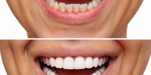 Teeth Bleaching