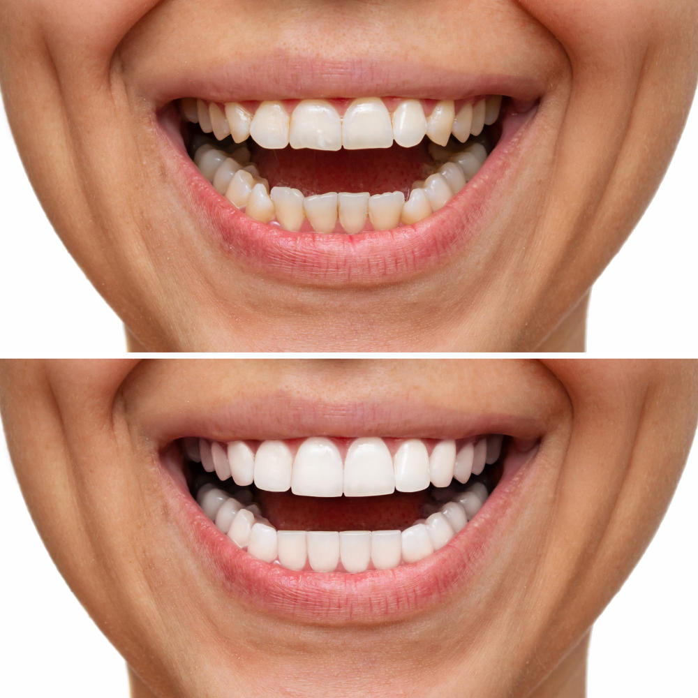 Teeth Bleaching