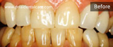 Teeth-Bleaching1