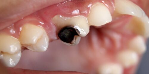 Tooth Decay