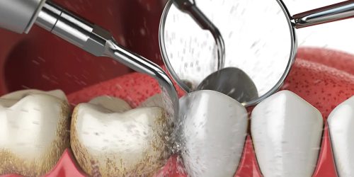 Ultrasonic-Fillings