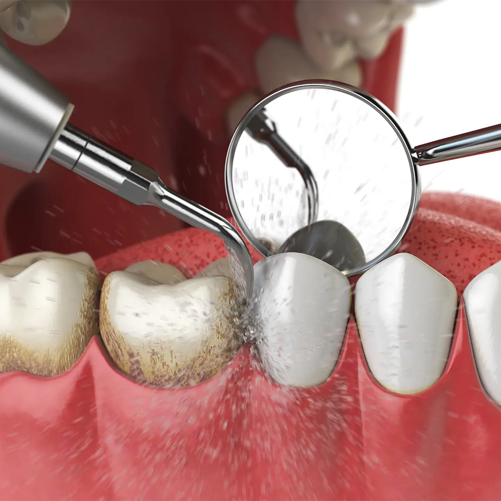 Ultrasonic-Fillings