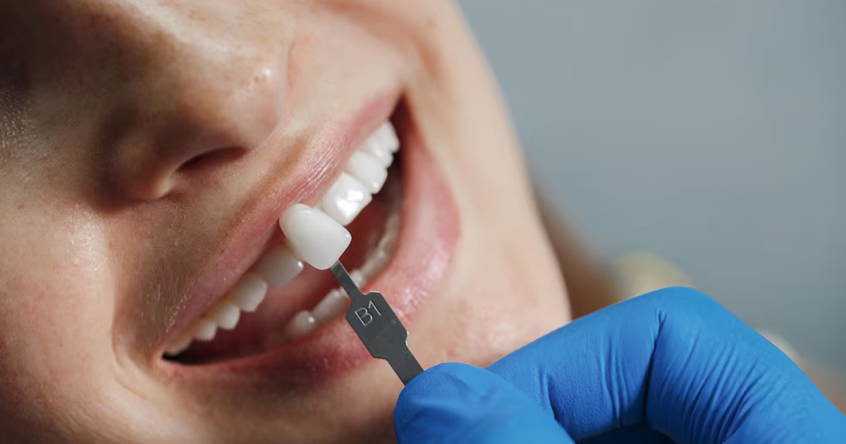 Why Dental Implants Might Be the Most Overlooked Anti-Aging Secret