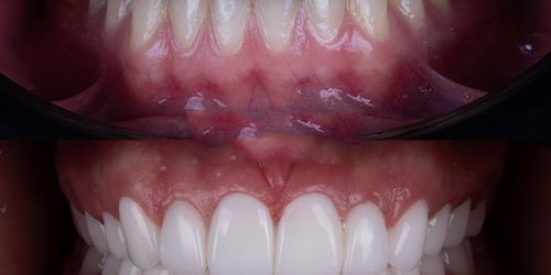 laminate-veneers