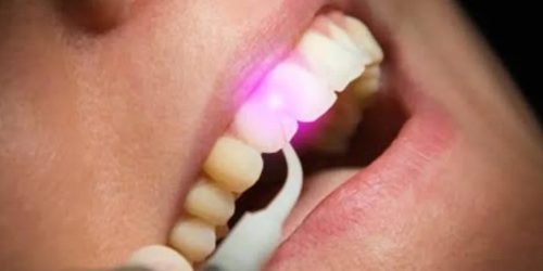 Laser Dentistry