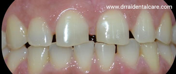 Laminate-Veneers-1
