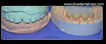 Laminate-Veneers-2