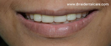 Laminate-Veneers-3