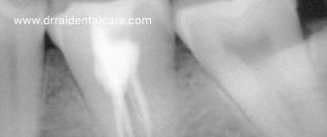 Root-Canal-Treatment1